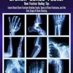 خرید و دانلود نسخه کامل کتاب زبان اصلی How to Heal Broken Bones Faster. Bone Fracture Healing Tips: Learn About Bone Fracture Healing Foods, Types of Bone Fractures, and the Five Stages of Bone Healing (Health and Wellness Book 5) | دانلود کتاب خارجی